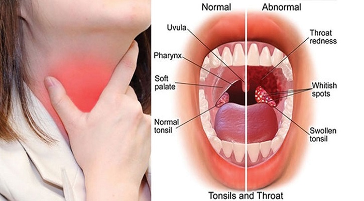 টনসিলের লক্ষণ ও প্রতিরোধের উপায়