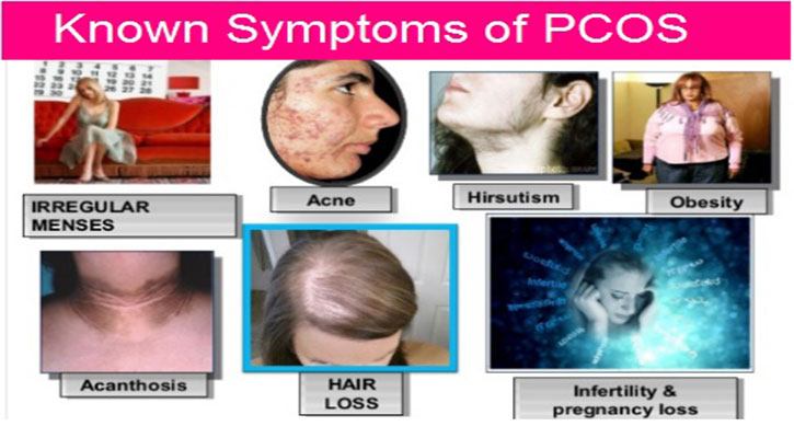 পলিসিস্টিক ওভারি সিন্ড্রোম বা PCOS কি?