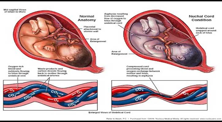 নিউকাল কর্ড! গর্ভে শিশুর গলায় পেঁচিয়ে যাওয়া
