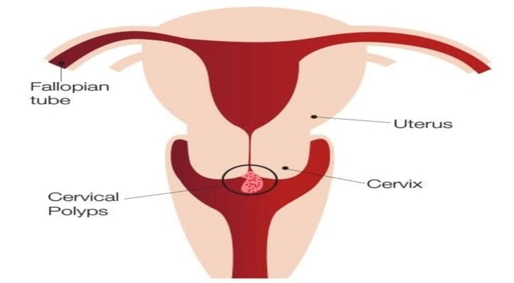 সার্ভাইকাল পলিপ! কেন হয়? প্রতিকার কী?