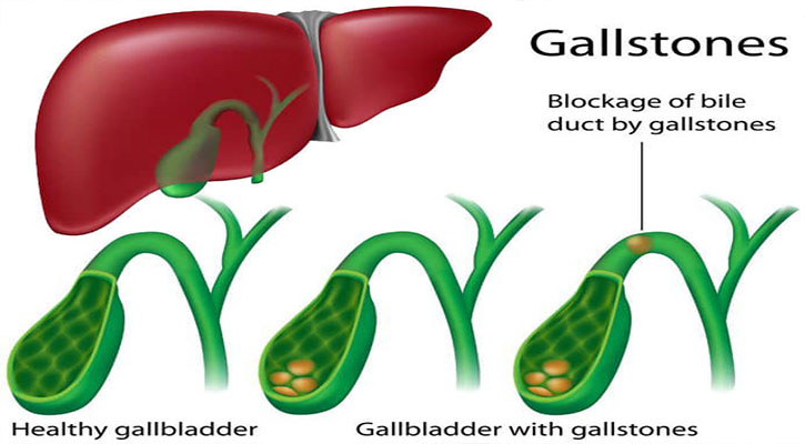 পিত্তথলিতে পাথর কেন হয় জানেন কি?