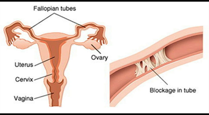 ফ্যালোপিয়ান টিউব ব্লক হওয়ার কারণ কী?