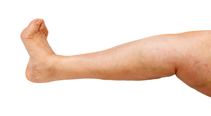 পায়ে পানি আসা (Peripheral edema)