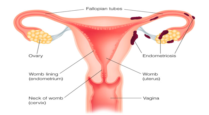 এন্ডোমেট্রিয়াম  (Endometriosis)