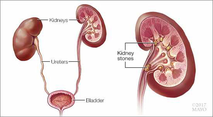 কিডনির পাথর হয়েছে তা কীভাবে বুঝবেন?