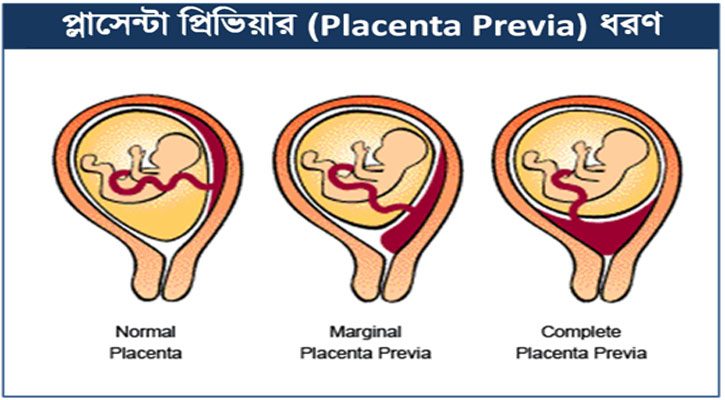 গর্ভাবস্থায় প্লাসেন্টা প্রিভিয়া জটিলতায় আপনার করণীয় কী ?