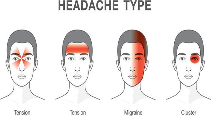 মাইগ্রেন কেন হয়? মাইগ্রেনের বিস্তারিত বর্ণনা 