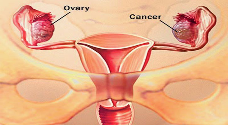 ওভারিয়ান ক্যান্সারের বাহক হতে পারেন আপনার পিতা!