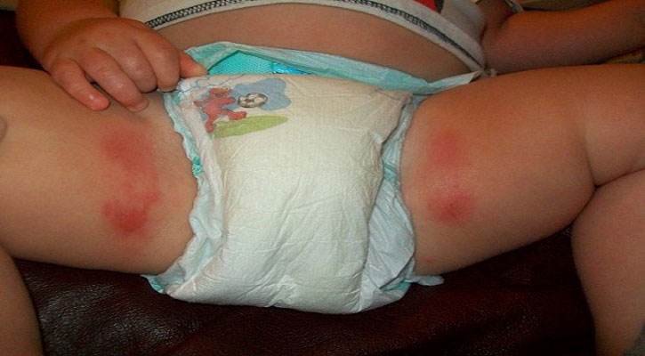 ডায়াপার র‍্যাশ কি, কেন হয় ?এবং এর  প্রতিকার