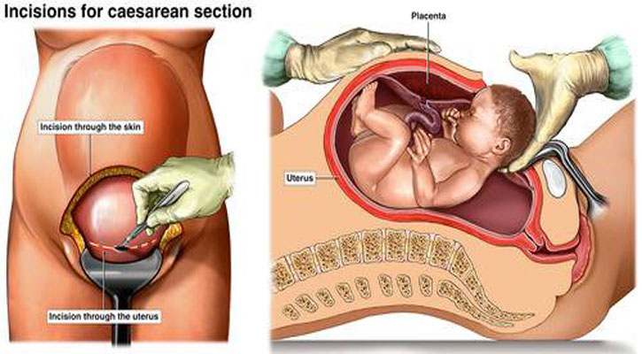 সিজারিয়ান ডেলিভারিতে কী হয় অপারেশন রুমে?