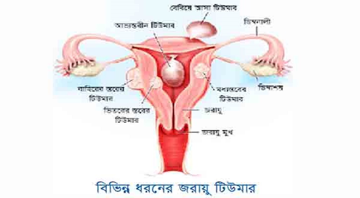 জরায়ুতে টিউমার কেন হয়? প্রাথমিক উপসর্গগুলো কি কি? জরায়ুতে টিউমার কেন হয়? প্রাথমিক উপসর্গগুলো কি কি?