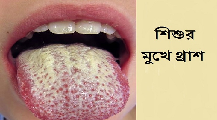 শিশুর মুখে থ্রাশ বা ইস্ট ইনফেকশন হওয়ার কারণ ও প্রতিকার শিশুর মুখে থ্রাশ বা ইস্ট ইনফেকশন হওয়ার কারণ ও প্রতিকার