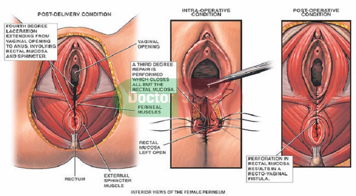 প্রসবজনিত ফিস্টুলা প্রতিরোধে করণীয়