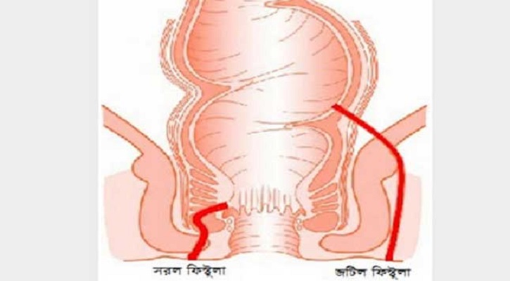 মলদ্বারে চুলকানির কারণ মলদ্বারে চুলকানির কারণ