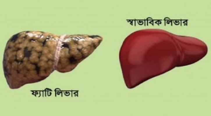 ফ্যাটি লিভার ফ্যাটি লিভার