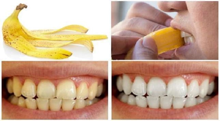 What Is Banana Peel Teeth Whitening?