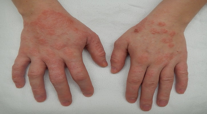 Eczema (Dermatitis) Eczema (Dermatitis)