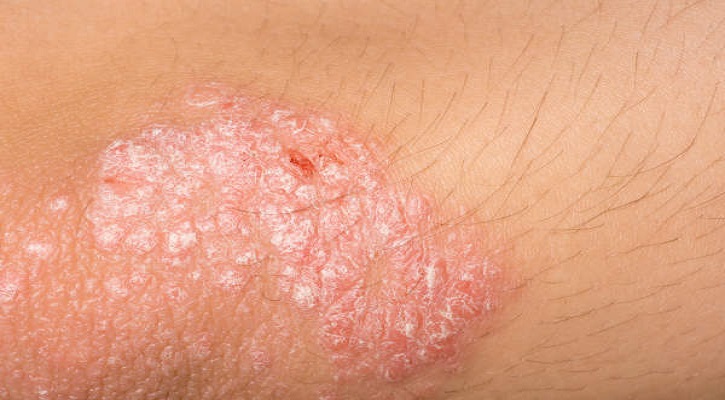 Psoriasis Psoriasis