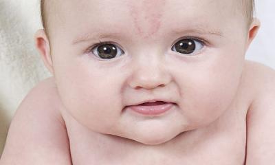 Some Treatments for Birthmarks