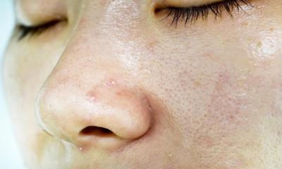 Symptoms of Oily Skin