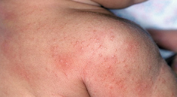 Baby‍‍`s Top Skin Irritants