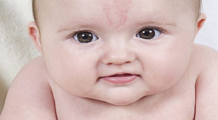 What Are the Causes of Birthmarks?