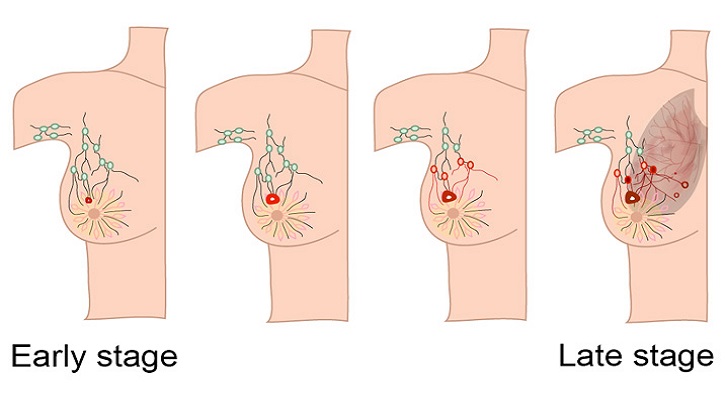 A Visual Guide to Breast Cancer