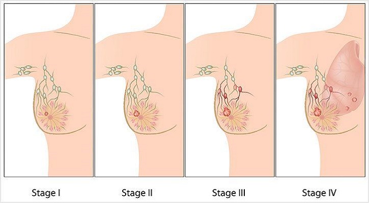 Stages of Breast Cancer