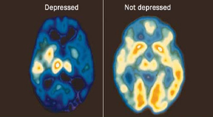 How Does Depression Affect the Brain?