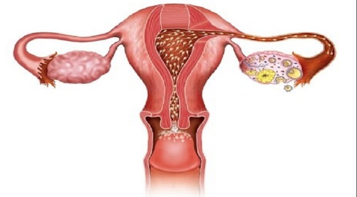 জরায়ু ক্যানসারের প্রধান লক্ষণ কী কী?