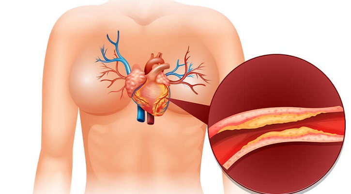 প্রাকৃতিক উপায়ে কমবে কোলেস্টেরলের মাত্রা