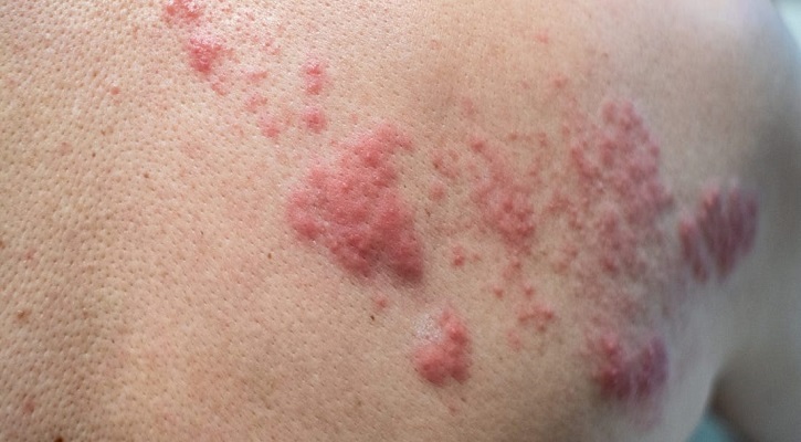 Shingles (Herpes Zoster) Shingles (Herpes Zoster)