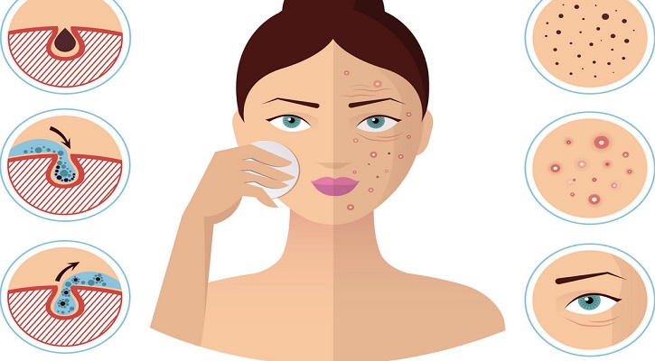 Daily Skincare Regime for Acne-Prone Skin