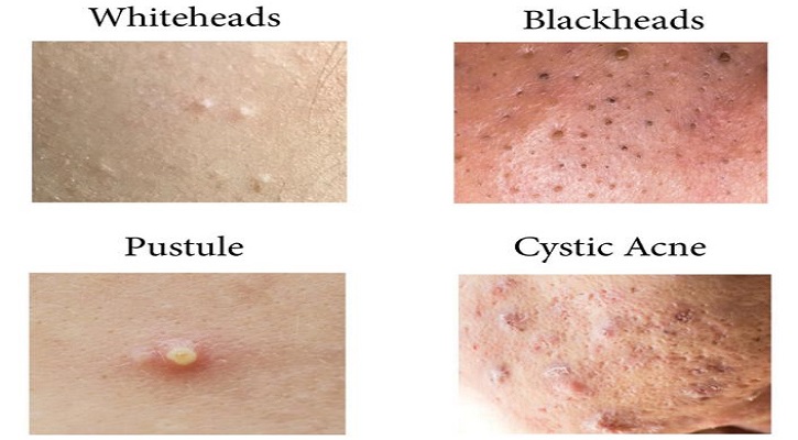 Types of Skin Pimples