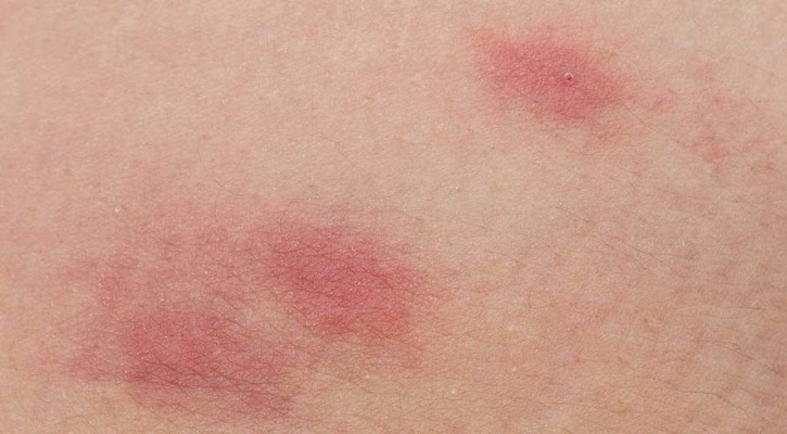Skin Rashes Skin Rashes