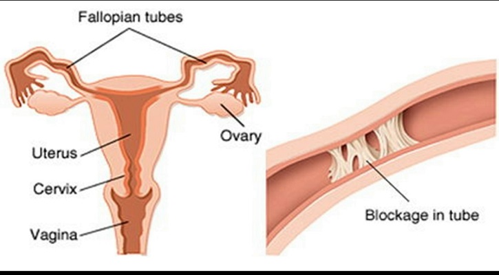 ফ্যালোপিয়ান টিউব ব্লকেজ কি বন্ধ্যাত্বের ঘটায়?