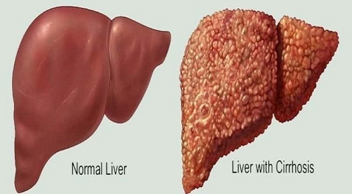 কেন হয় লিভার সিরোসিস ?