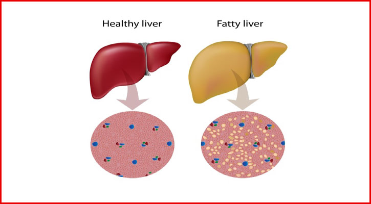 ফ্যাটি লিভারের গুরুতর যে লক্ষণ দেখা দেয় রাতে