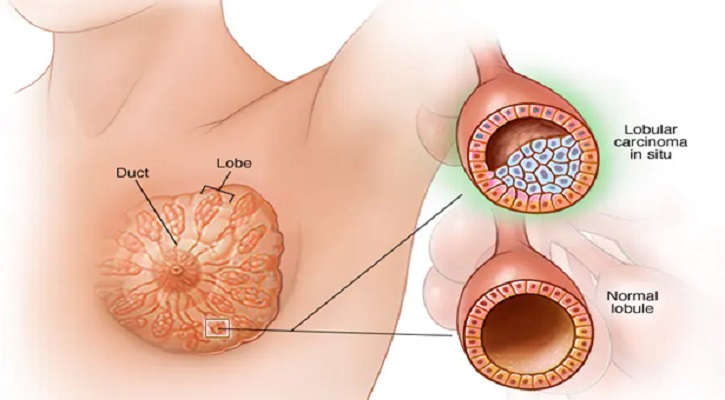 স্তনে চাকা মানেই কি ক্যানসার?