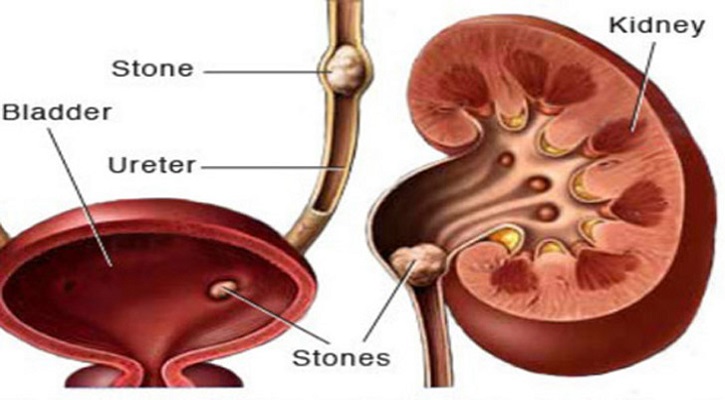 কিডনির পাথর দূর করার ঘরোয়া উপায়